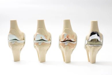 arthritis knee replacement - Dr Hesham Al Khateeb