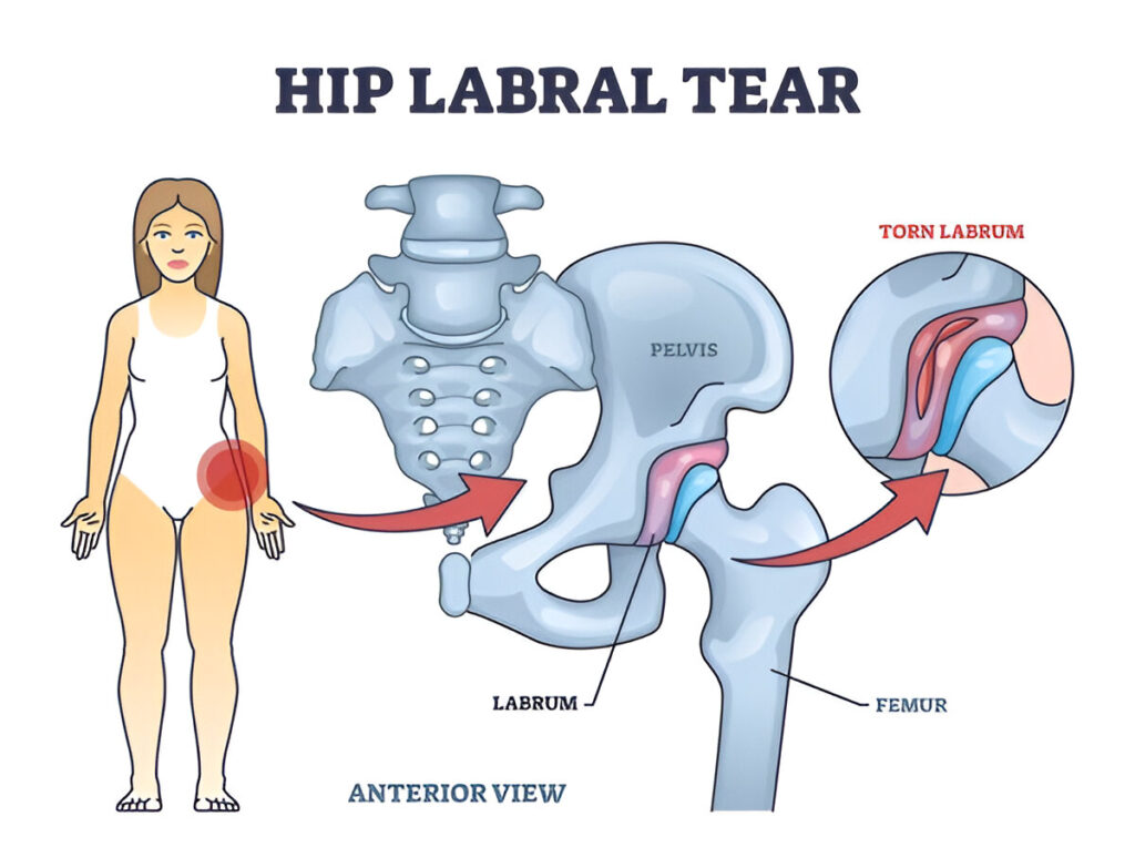 hip labral tear surgery recovery