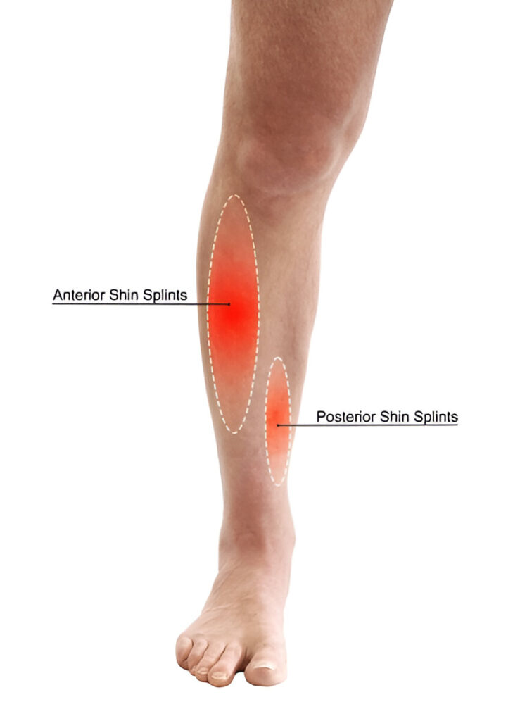 shin splints medication