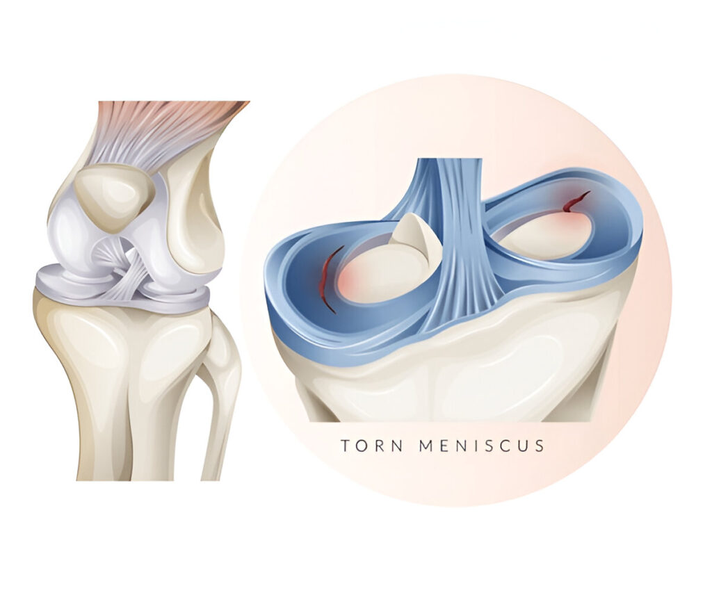 What Does A Torn Meniscus Look Like On The Outside