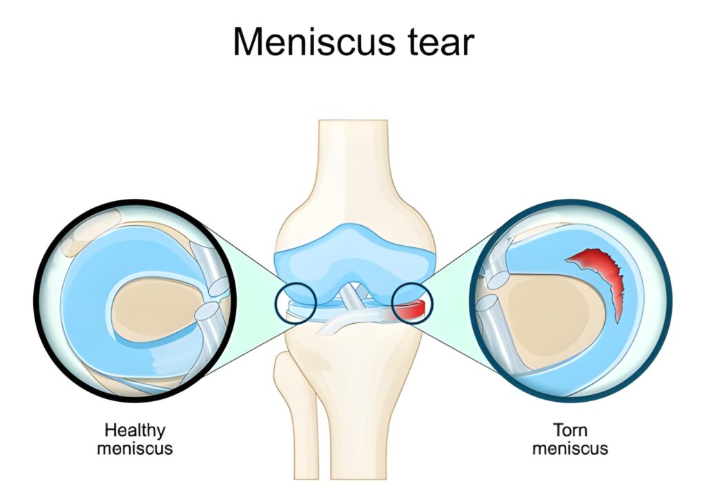 How to heal a torn meniscus naturally